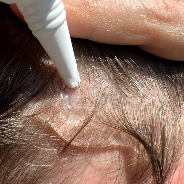 What nobody tells you about a thinning hairline